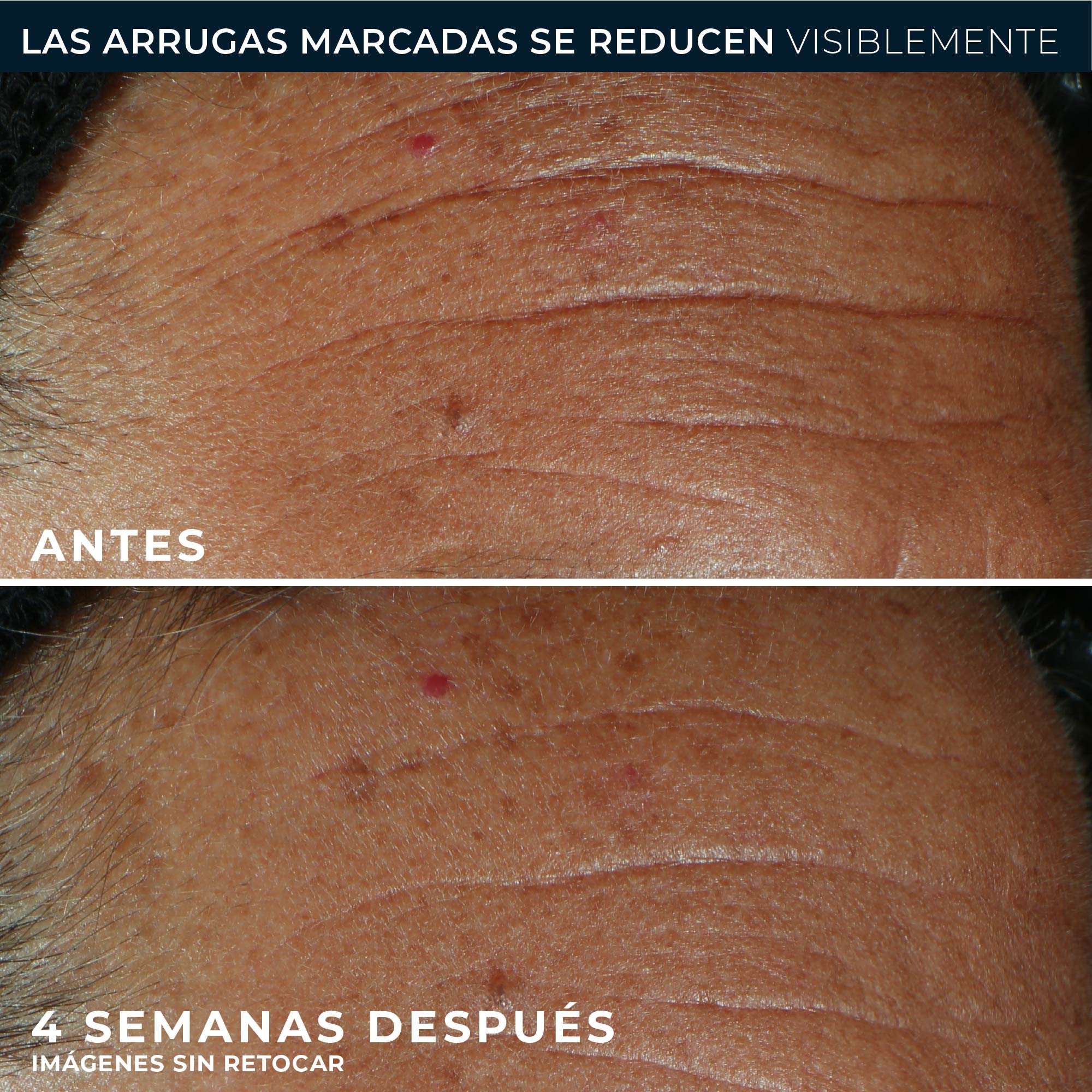 RoC® DERM CORREXION® FILL + TREAT 15ML